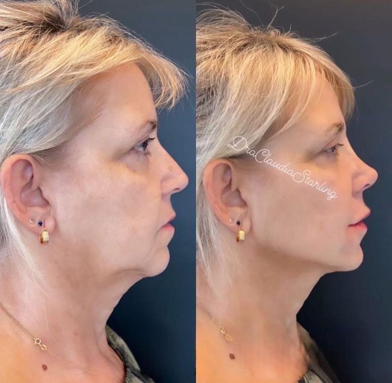 Antes e depois de paciente da Dra. Cláudia, perfil direito: contorno do queixo e da mandíbula mais definido