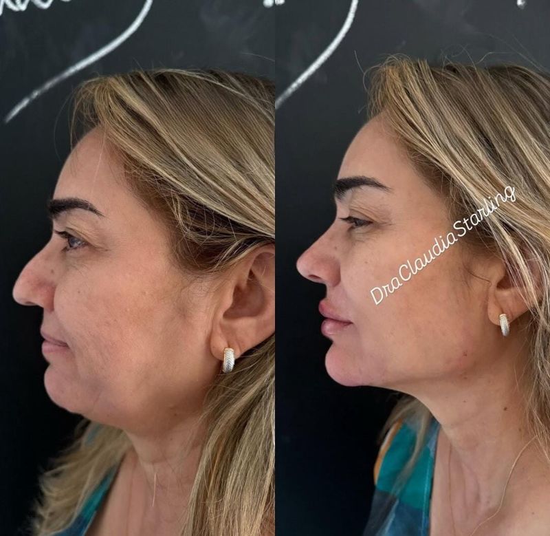 Antes e depois de paciente da Dra. Cláudia, perfil esquerdo: queixo e linha da mandíbula mais definidos