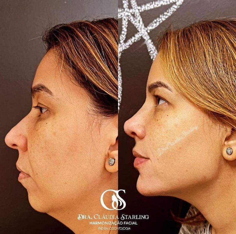 Antes e depois de paciente da Dra. Cláudia, perfil esquerdo: perfil do queixo e dos lábios mais equilibrado