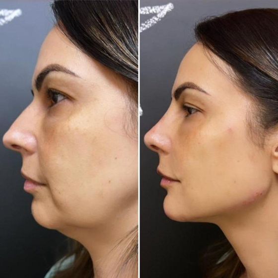 Antes e depois – Protocolo IArmonize Full Face
