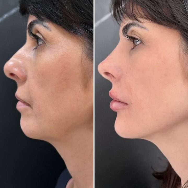 Antes e depois – Protocolo IArmonize Full Face