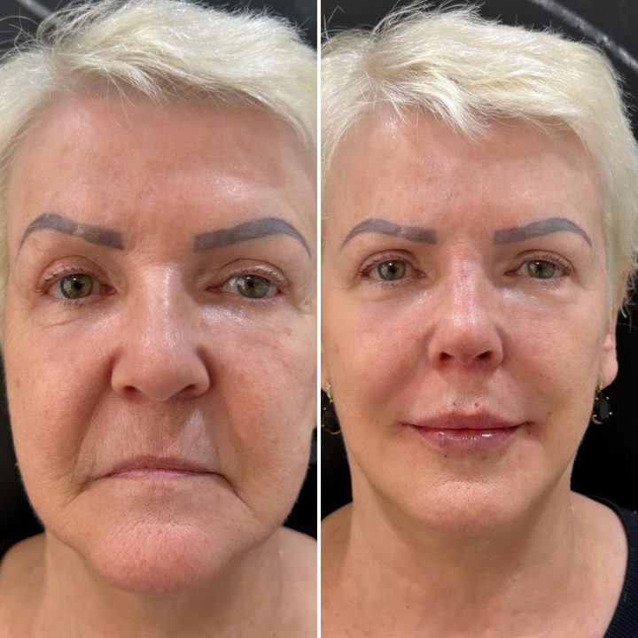 Antes e depois – Protocolo IArmonize Full Face